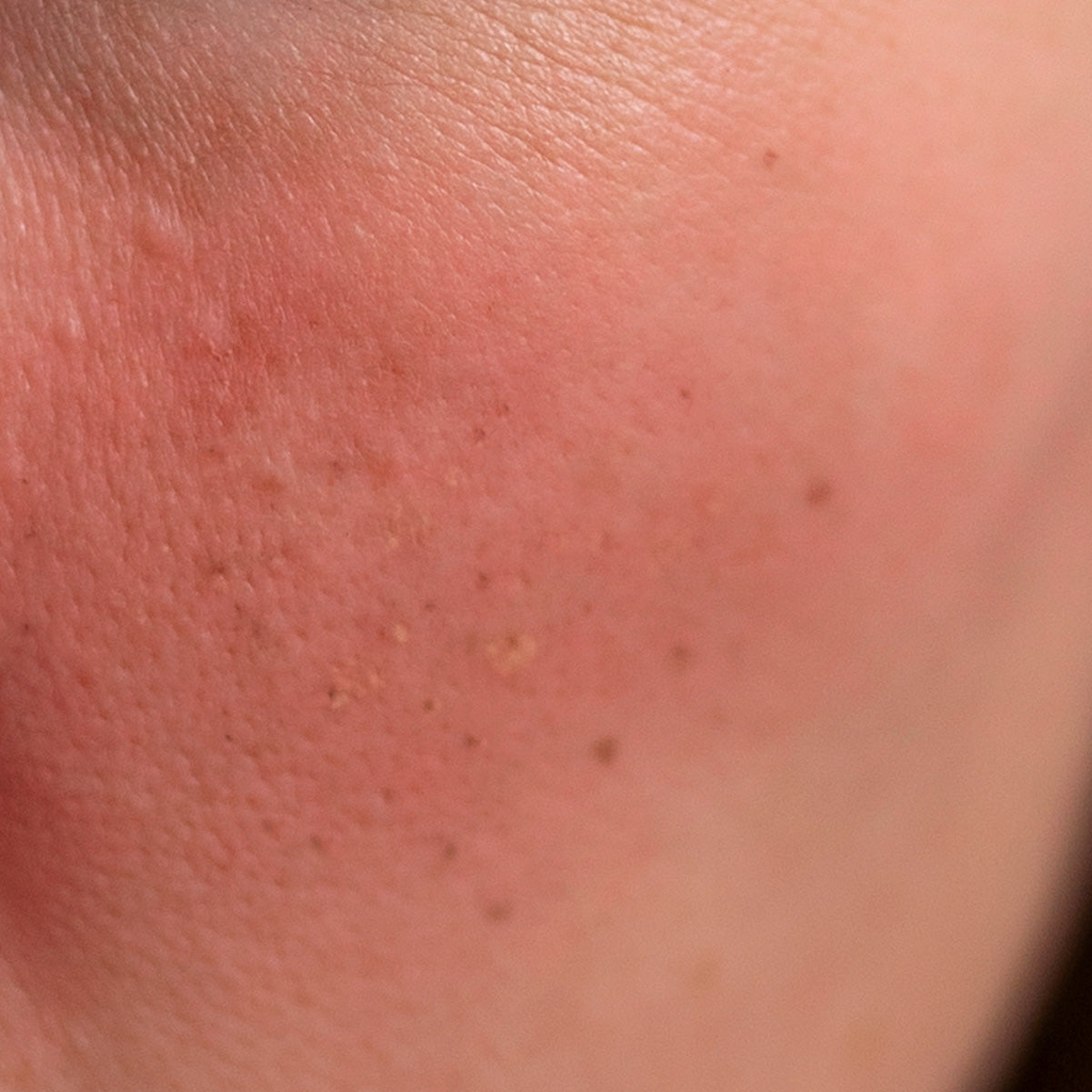 Senstive Skin