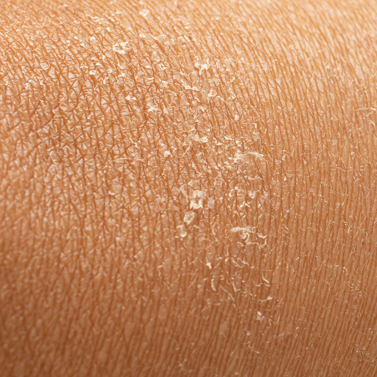 Dry Skin
